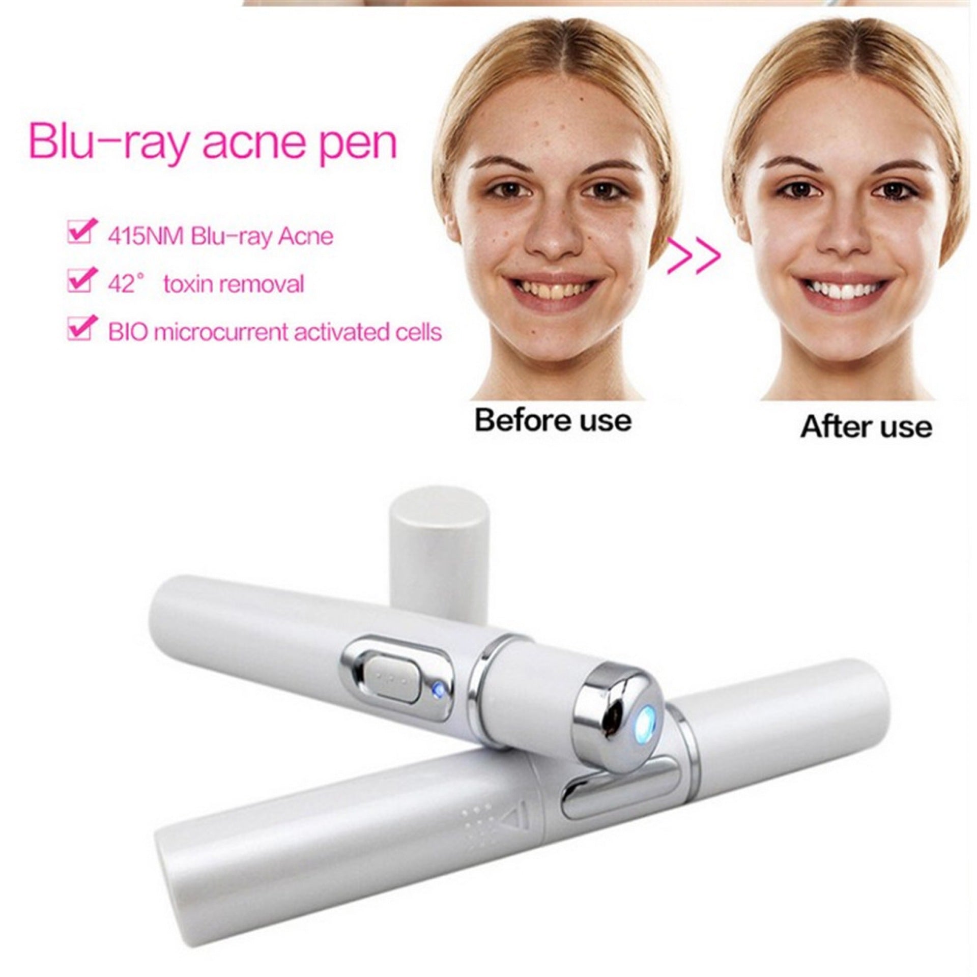 Blue Light Therapy Acne Laser Pen - PixelGlamour