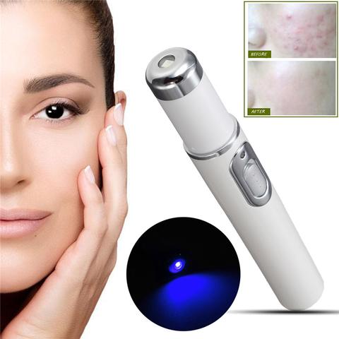 Blue Light Therapy Acne Laser Pen - PixelGlamour